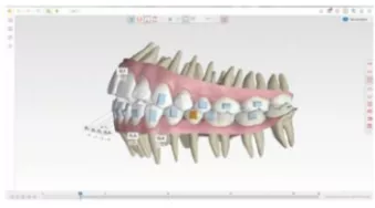 Spark Approver Screen shot showing the left side of the upper and lower jaw
