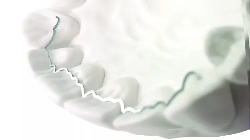 Memotain Dental expander on a model jaw