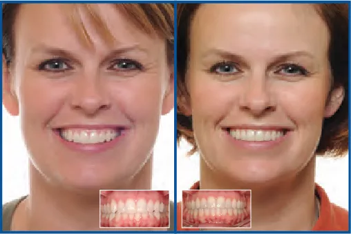 Clear Fixed Appliance vs. Aligner Treatment for Arch Development