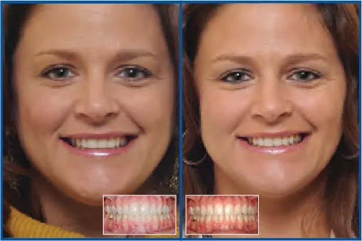 Clear Fixed Appliance vs. Aligner Treatment for Arch Development