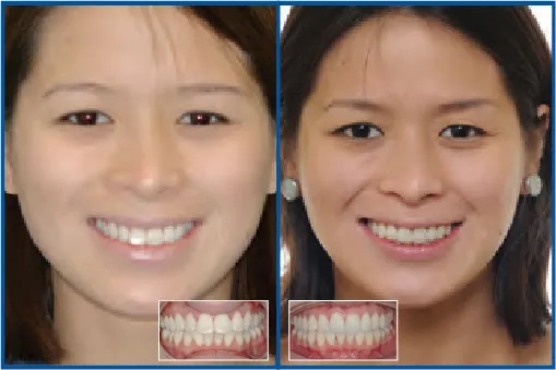 Bi-maxillary Protrusion Treated Nonextraction