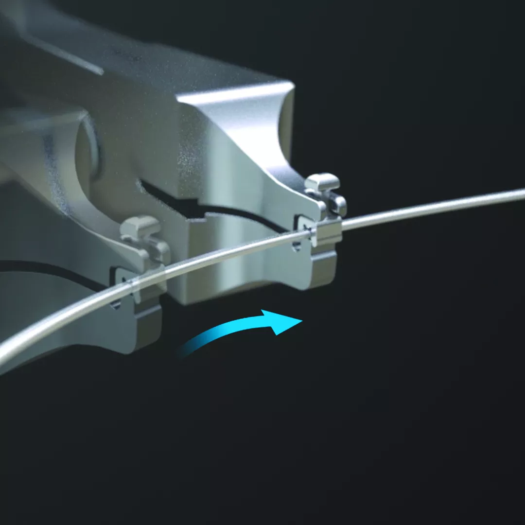 The Ultima Hook’s ability to act as a stop can minimize the need for power chains or ligatures while maintaining anterior space closure.