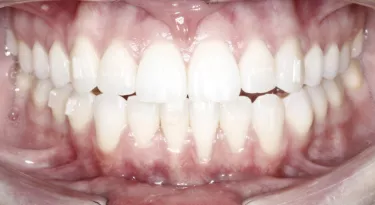 Patient showing molar buildups. 10 weeks 20 aligners