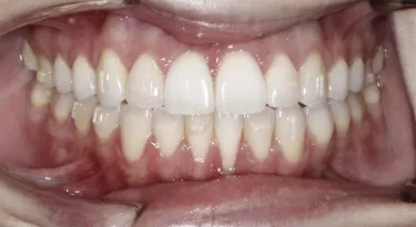Patient showing molar buildups. 18 weeks 31 aligners