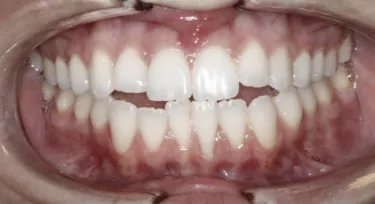 Patient showing molar buildups. Initial Image