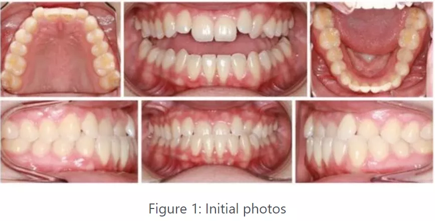 Pretreatment Photo panel of a patient's mouth.